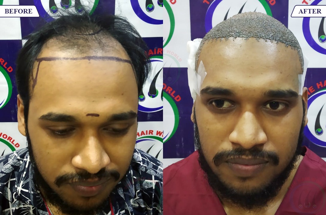 THE HAIR WORLD Clinic | There is One Most Important Factor in the Success  of Hair Transplant Surgery is the Training and Care