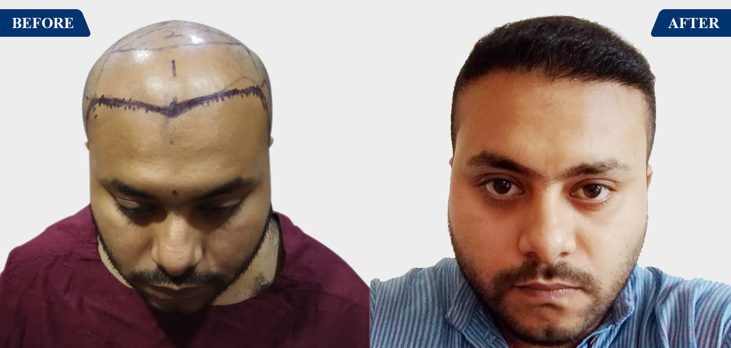 Hair Transplant Result